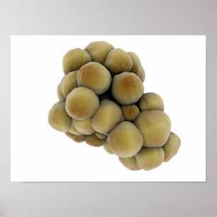 Mikroskopiskt beskåda av Tumor 5 Poster