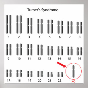 Monosomi X, Turnernas syndrom Poster