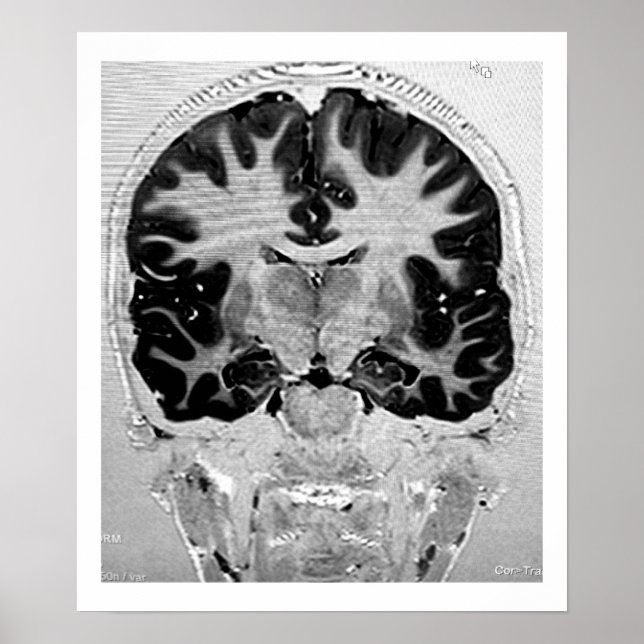 MRI Head Poster (Framsidan)