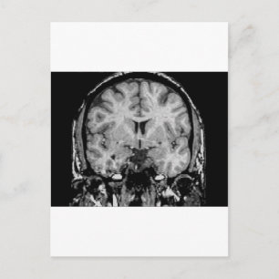 MRI-hjärna, koronssegment Vykort