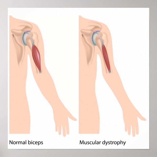 Muskeldystrofi Poster (Framsidan)