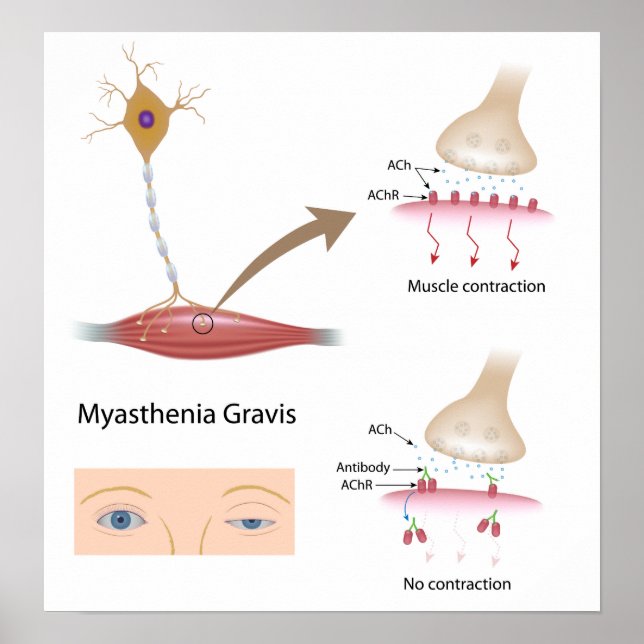 Myasthenia Gravis öga Poster (Framsidan)