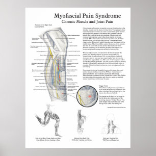 Myofascial Pain Syndrome Poster