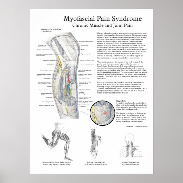 Myofascial Pain Syndrome Poster (Framsidan)
