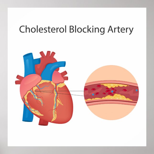 Narrogena blodkärl poster (Framsidan)