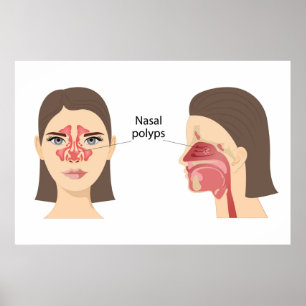 Nasala polyper poster