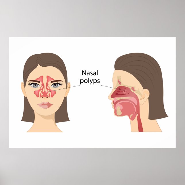 Nasala polyper poster (Framsidan)