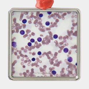 Neoplastic Lymphocyteceller Julgransprydnad Metall