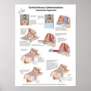 Netterdiagram: Central kateterisering på plats Poster
