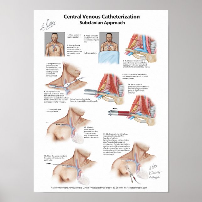 Netterdiagram: Central kateterisering på plats Poster (Framsidan)