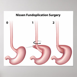 Nissen Fundoplication magkirurgi Poster