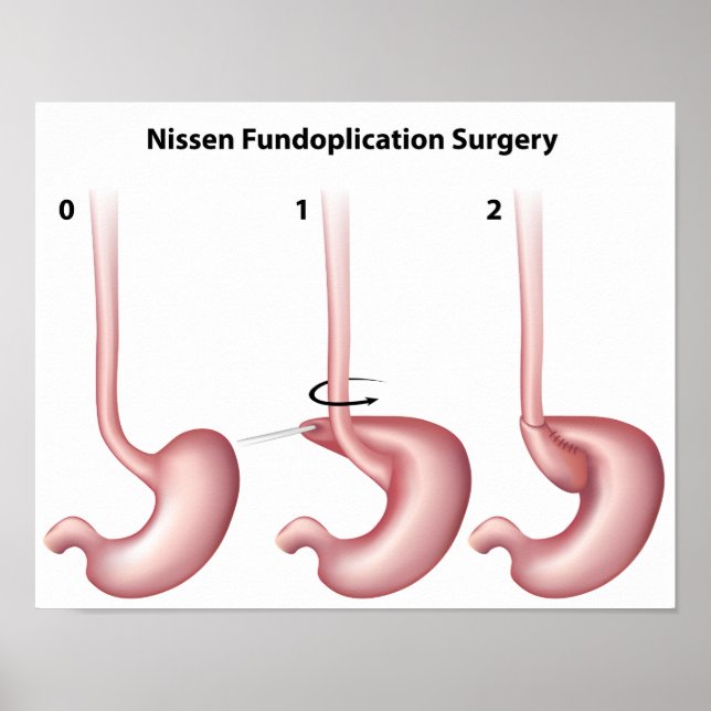 Nissen Fundoplication magkirurgi Poster (Framsidan)