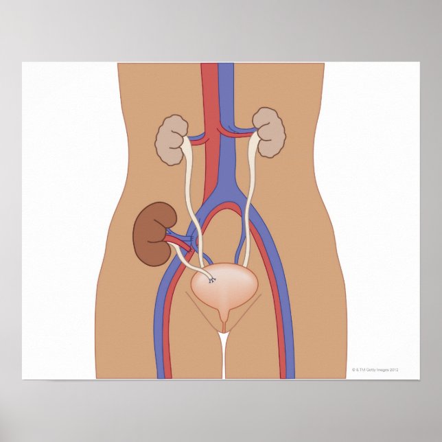 Njurtransplantation Poster (Framsidan)