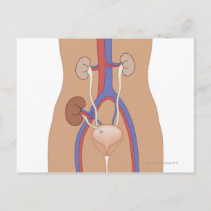 Njurtransplantation Vykort