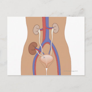Njurtransplantation Vykort