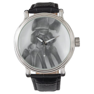 Normal handledning, röntgenstråle armbandsur