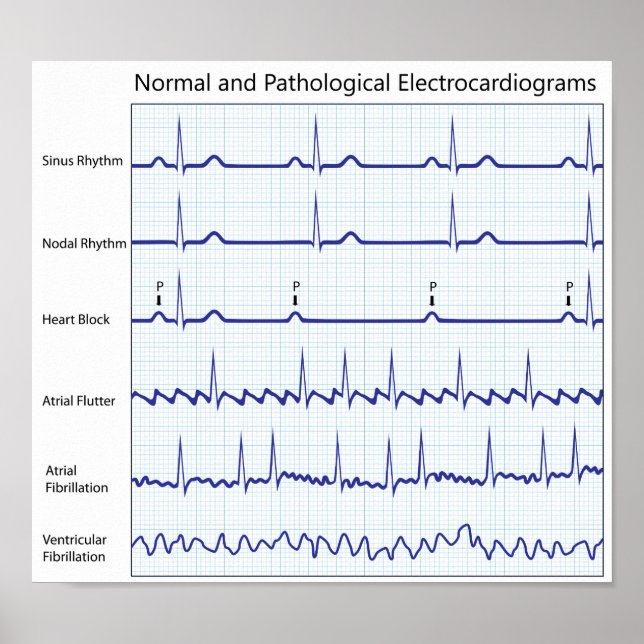 Normal och patologisk EKG Poster (Framsidan)