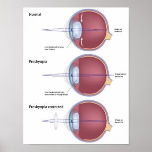 Öga defekt presbyopopia Poster