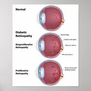 Öga sjukdom Diabetesretinopati Poster