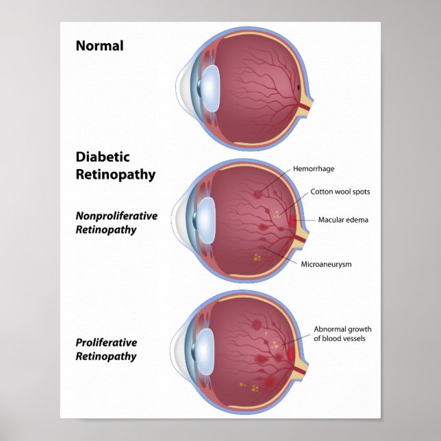 Öga sjukdom Diabetesretinopati Poster (Framsidan)