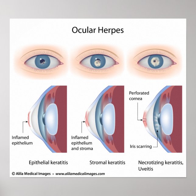 Okulär herpes-infektion, märkta diagram poster (Framsidan)
