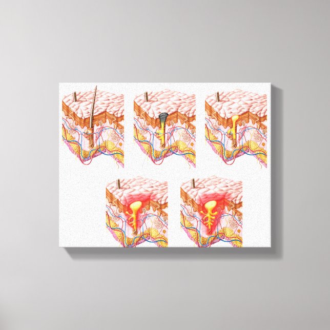 Olika typer av akne canvastryck (Framsida)