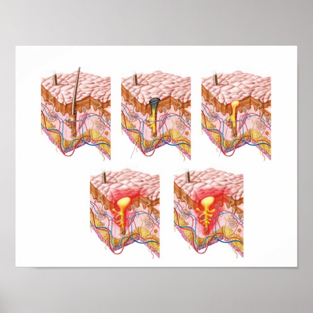 Olika typer av akne poster (Framsidan)