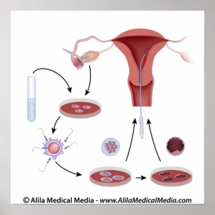Omärkt diagram för IVF-procedur. Poster