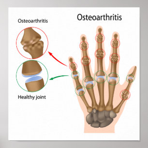 Osteoarthritis av räckaaffischen poster