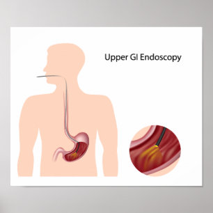 Övre GI-endoskopi Poster
