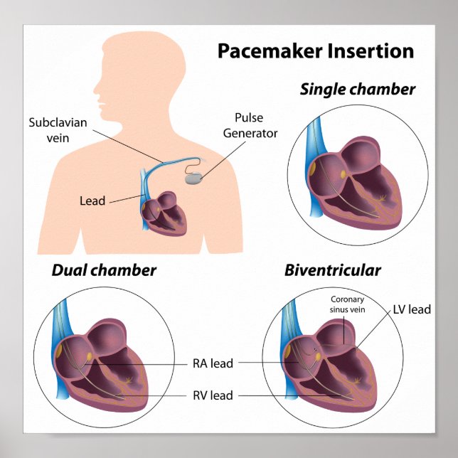 Pacemaker-ingrepp Poster (Framsidan)