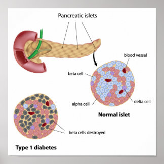 Pankreatiska sjukdomar och diabetes Poster