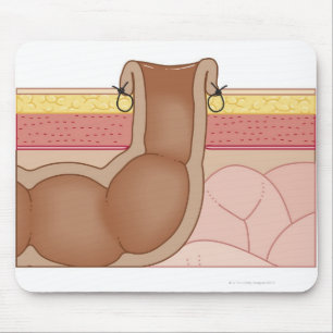 Permanent Colostomy Musmatta