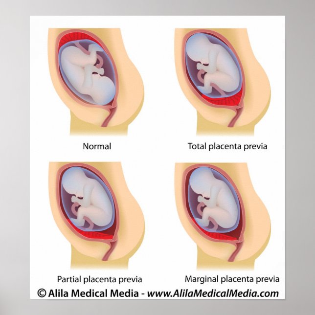 Placenta previa poster (Framsidan)
