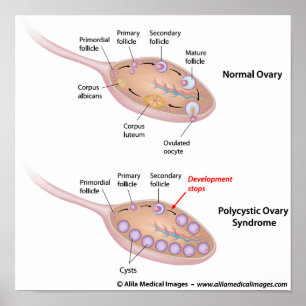 Polycystiskt ovariesyndrom, märkt diagram. poster