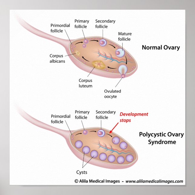 Polycystiskt ovariesyndrom, märkt diagram. poster (Framsidan)