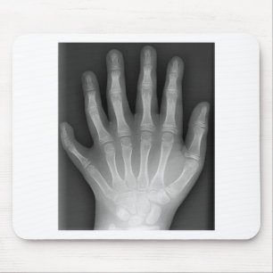 Polydactyly fingrad sex räcker, röntgar, musmatta