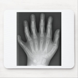 Polydactyly fingrad sex räcker, röntgar, musmatta
