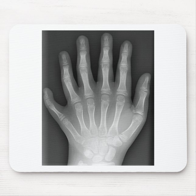 Polydactyly fingrad sex räcker, röntgar, musmatta (Framsidan)