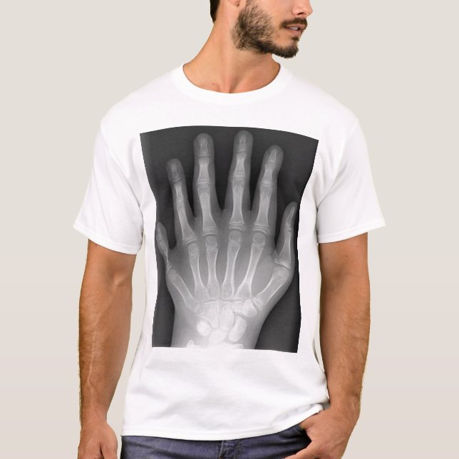 Polydactyly fingrad sex räcker, röntgar, t-shirt (Framsida)