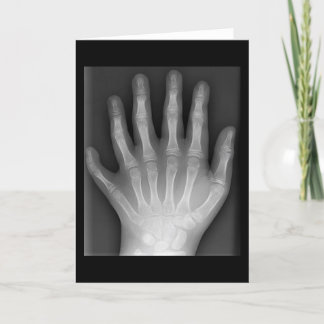 Polydactyly, sex fingered Hand, X-Ray, rarity! Kort