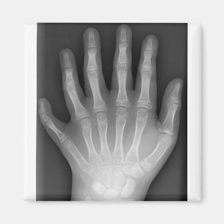 Polydactyly, sex fingered Hand, X-Ray, rarity! Magnet