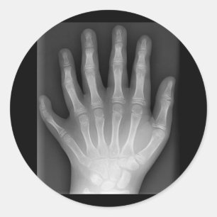 Polydactyly, sex fingered Hand, X-Ray, rarity! Runt Klistermärke