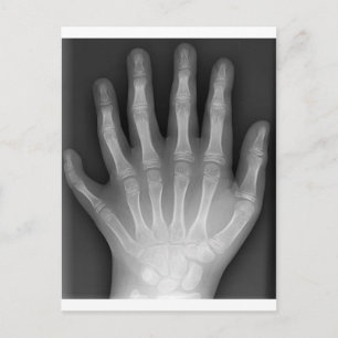 Polydactyly, sex fingered Hand, X-Ray, rarity! Vykort