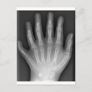 Polydactyly, sex fingered Hand, X-Ray, rarity! Vykort