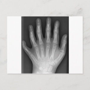 Polydactyly, sex fingered Hand, X-Ray, rarity! Vykort