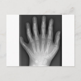 Polydactyly, sex fingered Hand, X-Ray, rarity! Vykort