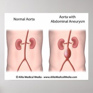 Poster av buksmärtor Aortiskt Aneurysm