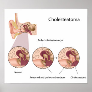 Poster av Cholesteatoma mitten örttumör
