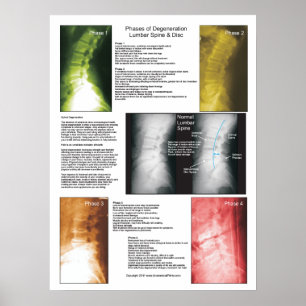 Poster av faser Lumbar ryggmärgsdegeneration